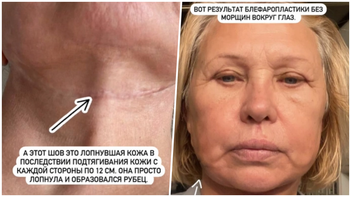 Когда красота становится абсурдом. Звезды и их пластические операции Когда красота становится абсурдом. Звезды и их пластические операции